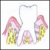 Presurgical bone defect