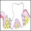 Flap incision to make gum retracted