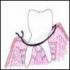 Gum is sutured back