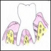 healthy gum after periodontal surgery