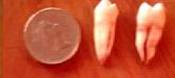 2 extracted teethfrom a 14 year old boy, compared against a £1 coin.